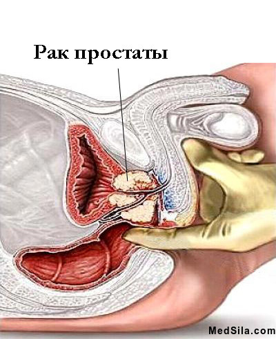 Рак простаты